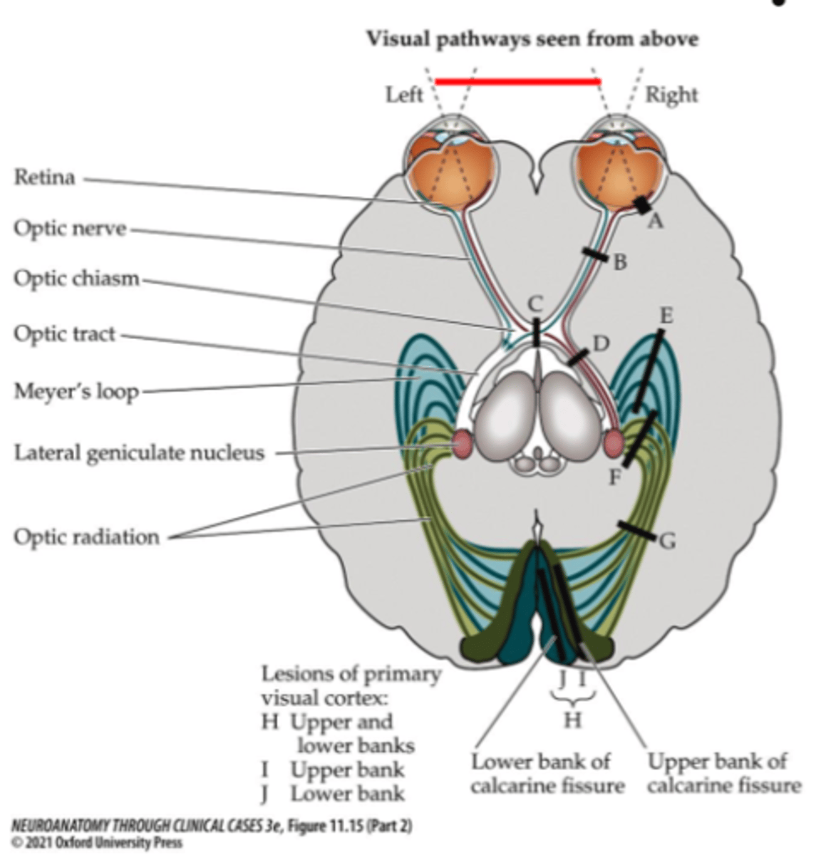 <p>Right inferior bank of calcarine fissure</p>