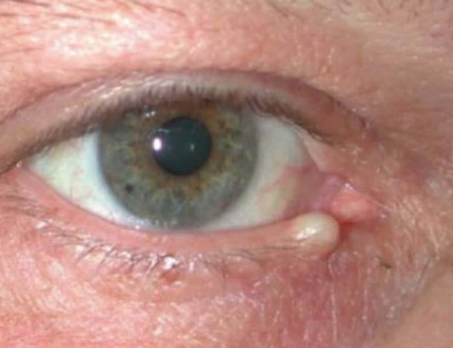 <p>occluded gland of Zeis = sebum-filled opaque yellow lesion near lid margin</p>