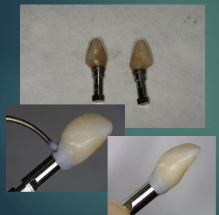 <ul><li><p>clean and disinfect provisional crowns and connect analogs </p></li><li><p>tighten abutment screws </p></li><li><p>apply thin layer of wax around the analog- restoration interface </p><ul><li><p>will simplify removal from cast </p></li></ul></li></ul><p></p>