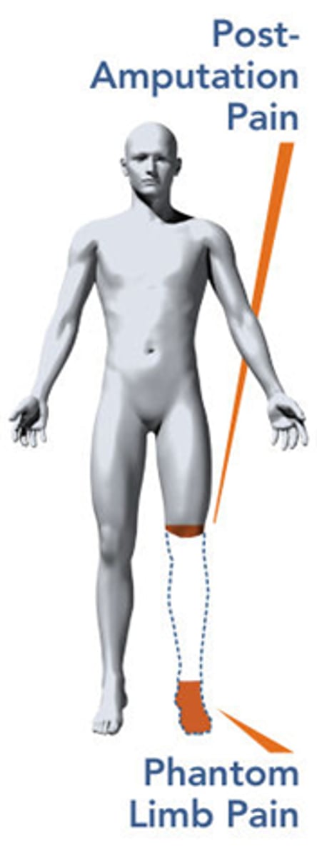 <p>An individual experiences pain where a lost limb once was</p>