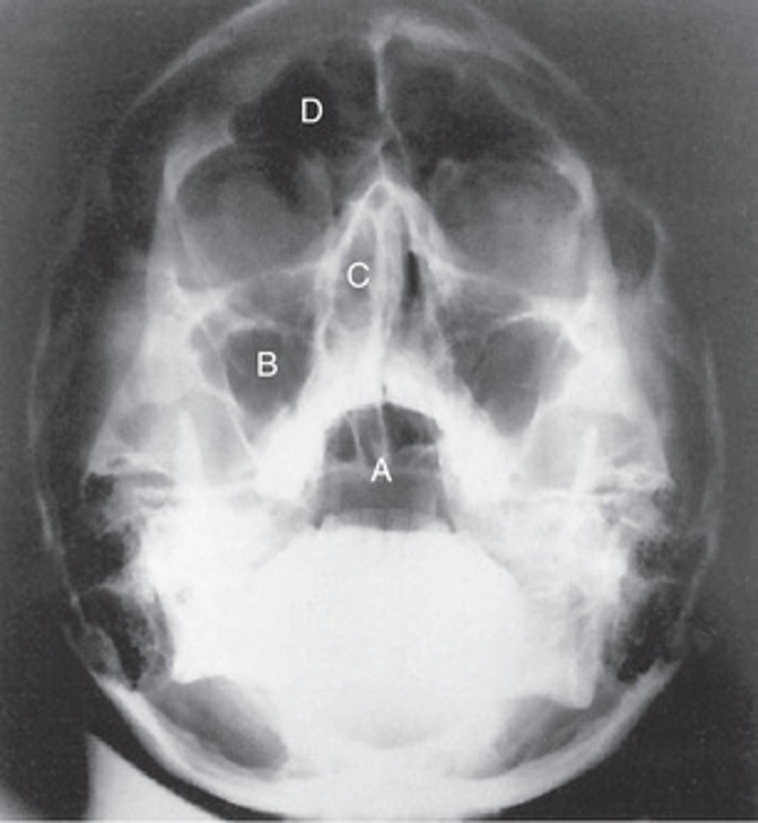 <p>A. Sphenoid sinus</p><p>B. Maxillary sinuses</p><p>C. Ethmoid sinuses</p><p>D. Frontal sinus</p>