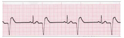 <p>What can be seen here? </p><p>-Refers to the presence of a PVC after each normal beat</p>