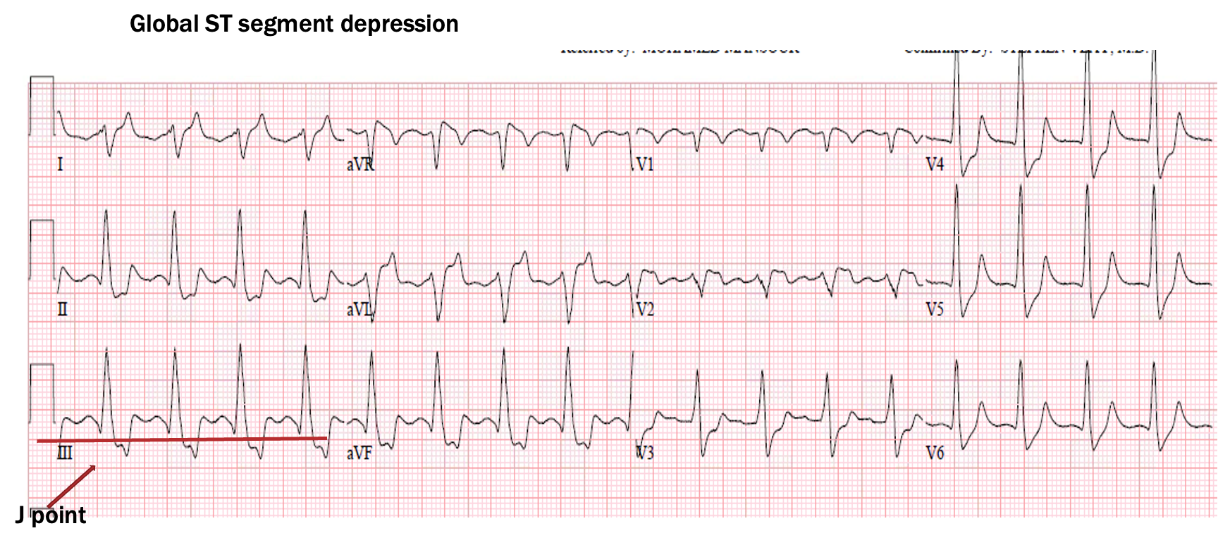 <p>ST seg depression</p>