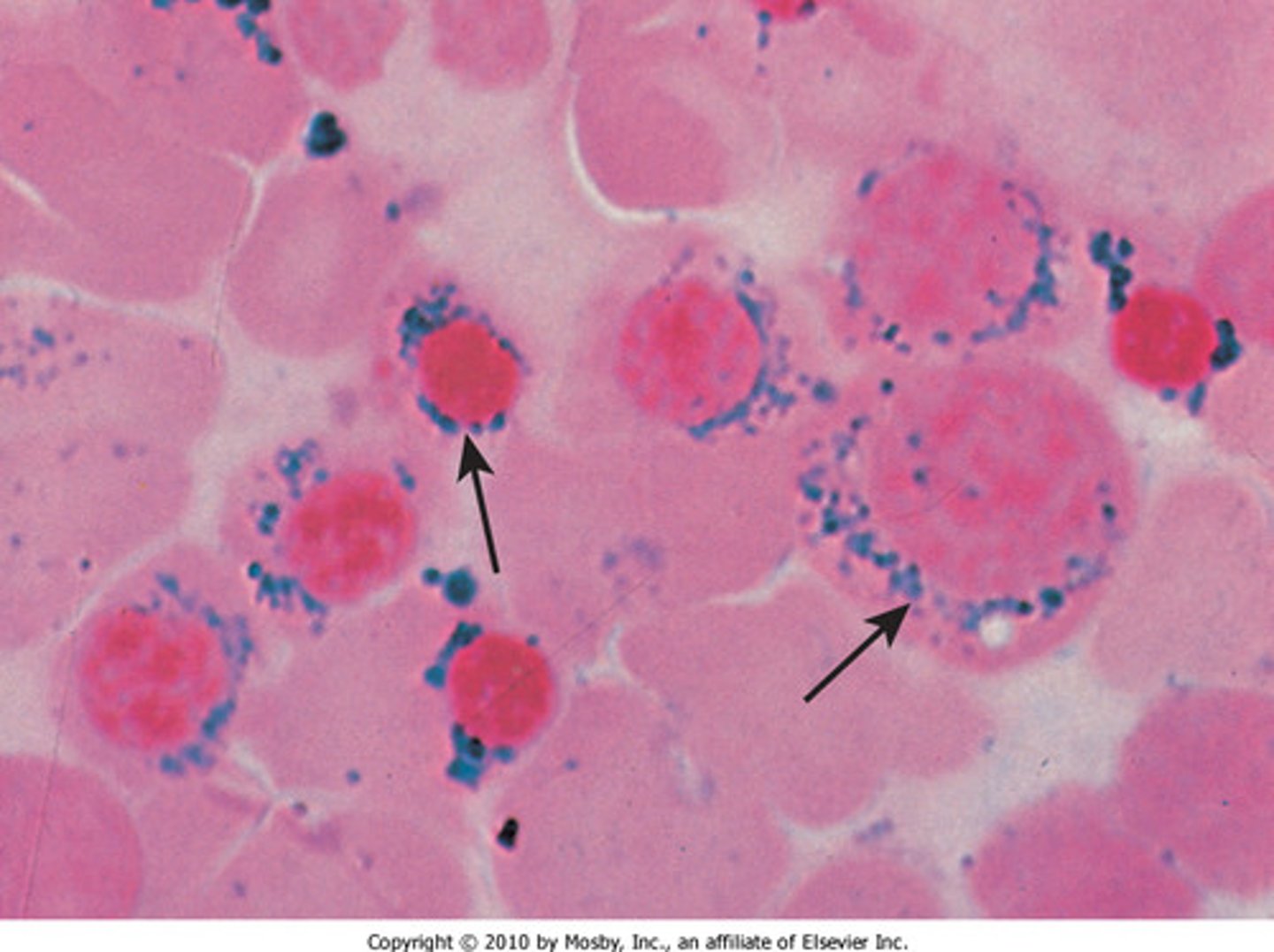 <p>- Erythroid hyperplasia<br>- increased iron in mitochondria= ringed sideroblasts</p>