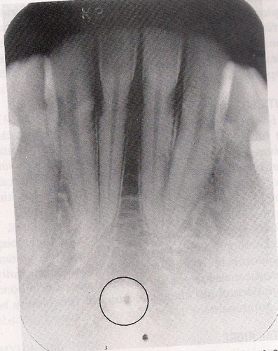 <p>Surrounds lingual foramen</p>