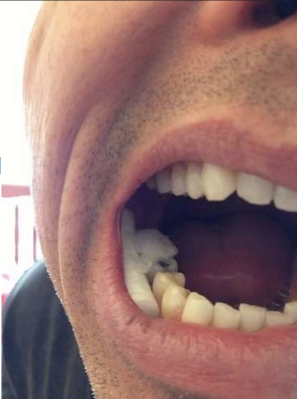 <ul><li><p>Medicament concentrated against the tissue</p><ul><li><p>e.g., Acid etch solution</p></li></ul></li><li><p>Removal without first moistening strips mucosa</p></li></ul><p></p>