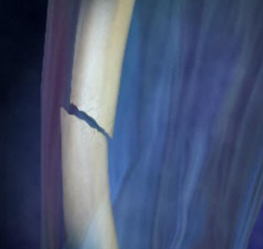 Simple fracture
