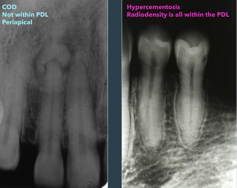 <ul><li><p>COD: not within PDL space </p></li><li><p>hypercementosis: within PDL space </p></li></ul><p></p>