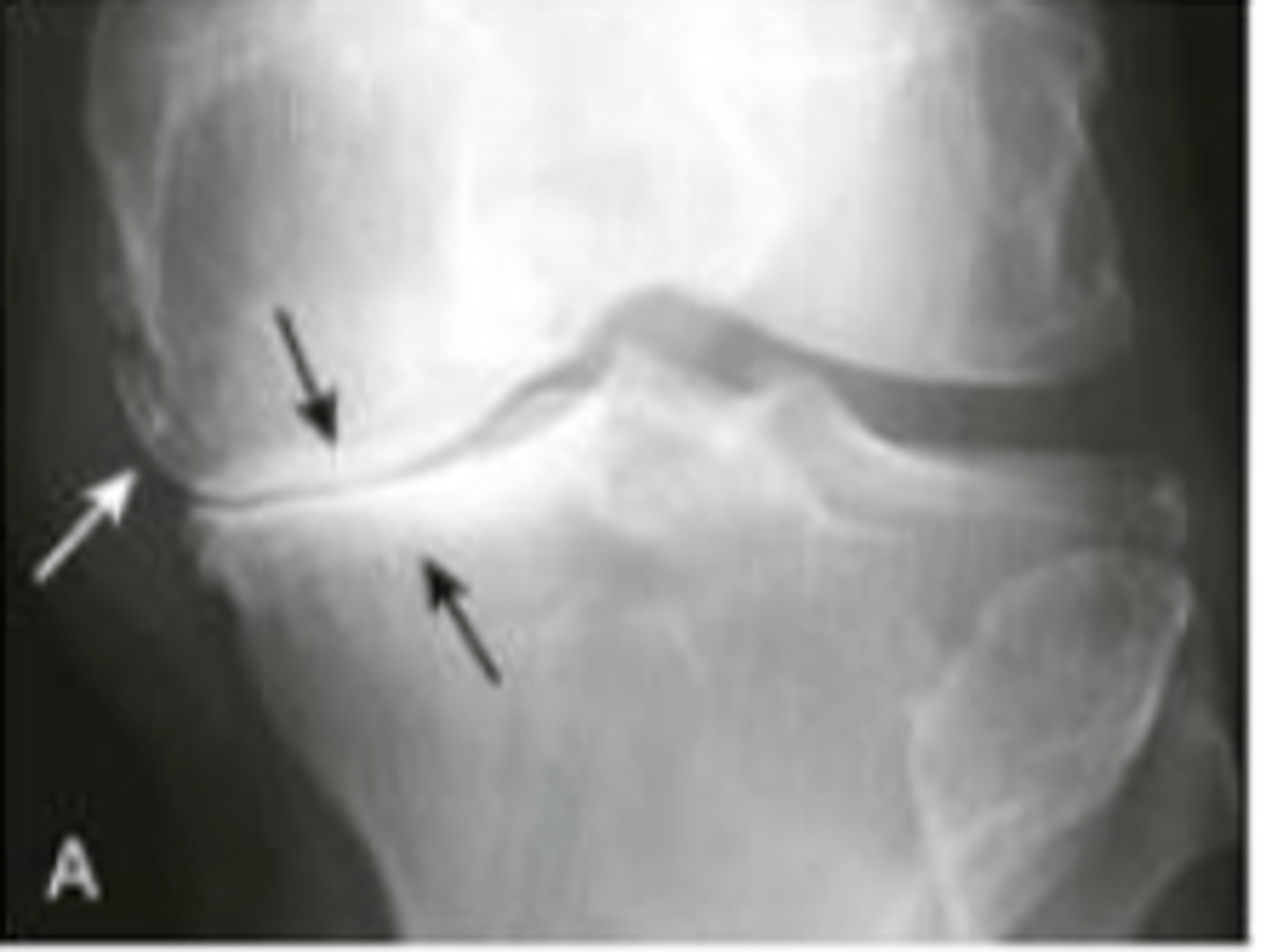 <p>bone formation at the site of involved joint</p><p>primary osteoarthritis- mechanical stress</p><p>secondary arthritis- trauma/infections/etc..</p><p>charcot arthopathy</p><p>- osteophyte formations</p><p>- subchondral sclerosis</p><p>- subchondral cysts</p><p>- narrowing of joint space</p>