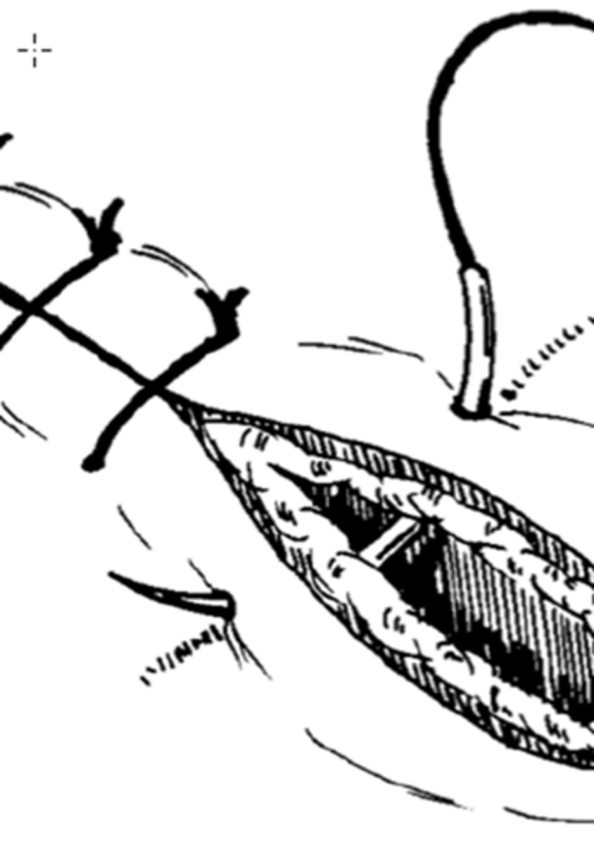 <p>easiest pattern to learn, appositional, provides secure closure, avoid excessive tension on tissue</p>