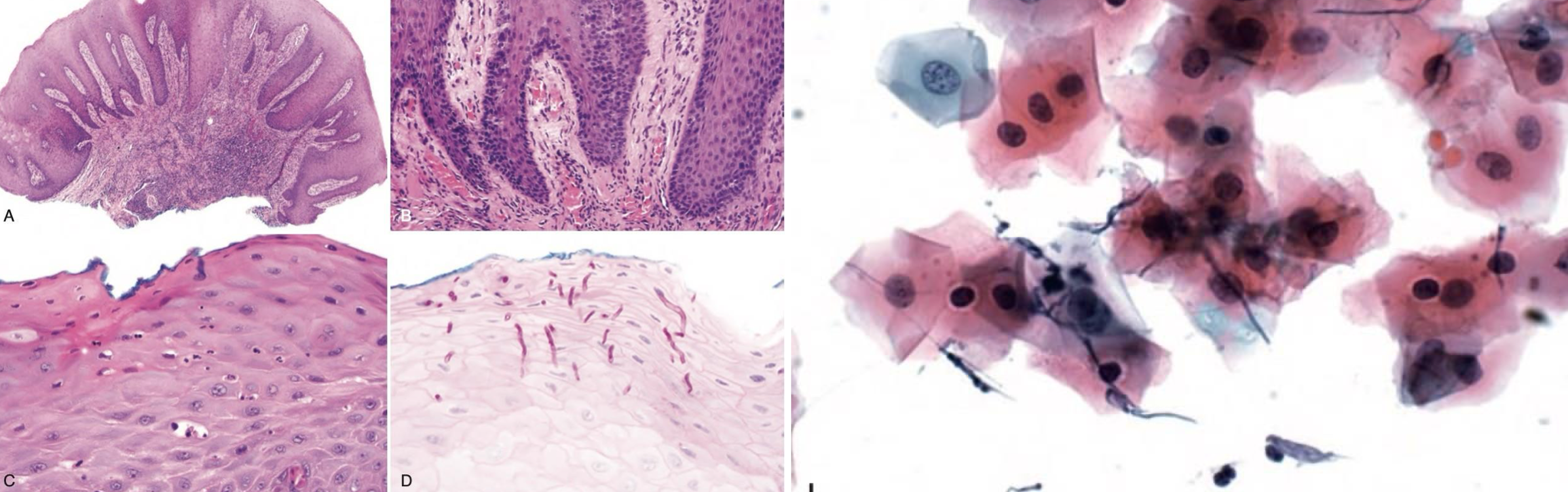 <p>infectious lesion: hyphae w/in keratinocytes, biomorphic forms and cytology of epithelial cells</p>