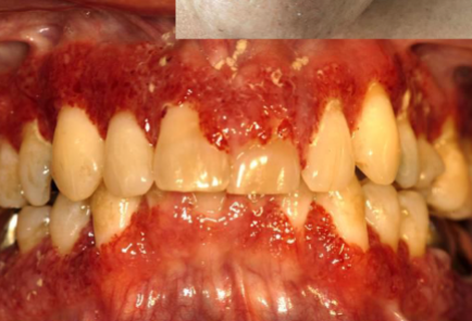 <p><strong>COMPLEMENT</strong>-mediated disease that causes “strawberry gums”</p>