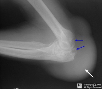 <p>Bursitis</p>