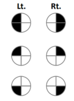 <p>A patient presenting with this visual defect likely has a lesion where</p>