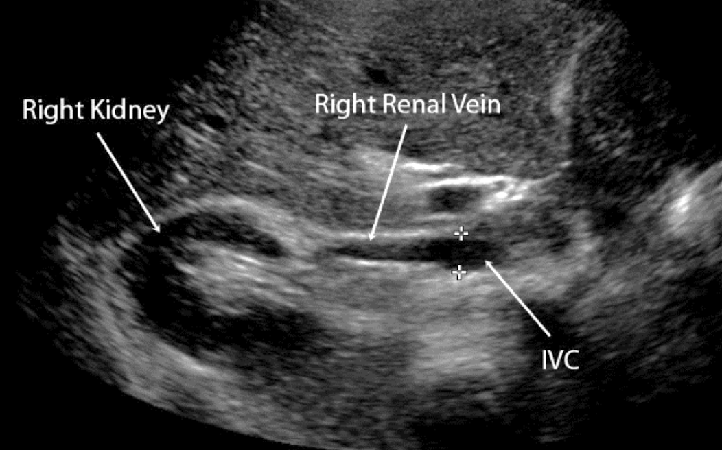 <p>what is the course of the RRV?</p>