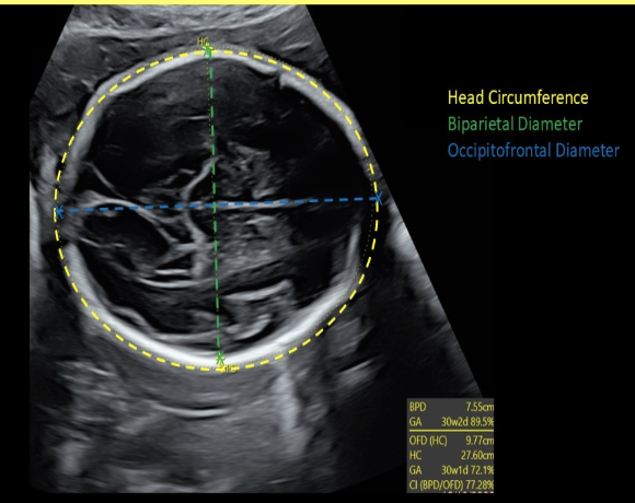 <p>how to properly perform the <strong>occitpital-frontal (OFD) </strong>measurement of a fetus</p><p>.</p><p>a) <strong><em><u>coronal</u></em></strong> view of fetal head w/calipers placed from leading edge of the cranium</p><p>b) <strong><em><u>axial</u></em></strong> view of fetal head w/calipers placed from <strong>outer frontal edge</strong> to <strong>outer occipital edge</strong> of the cranium</p><p>c) <strong><em><u>axial</u></em></strong> view of fetal head w/calipers placed from the <strong>outer edge</strong> of one side of the cranium to the <strong>opposing outer edge</strong> of the cranium</p><p>d) <strong><em><u>axial</u></em></strong> view of fetal head w/calipers placed from side to side on <strong>outer edge</strong> of one side of the cranium to the <strong>opposing inner edge</strong> of the cranium</p>