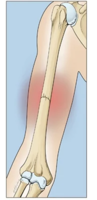 <p>Bone breaks but<strong> stays aligned</strong></p>