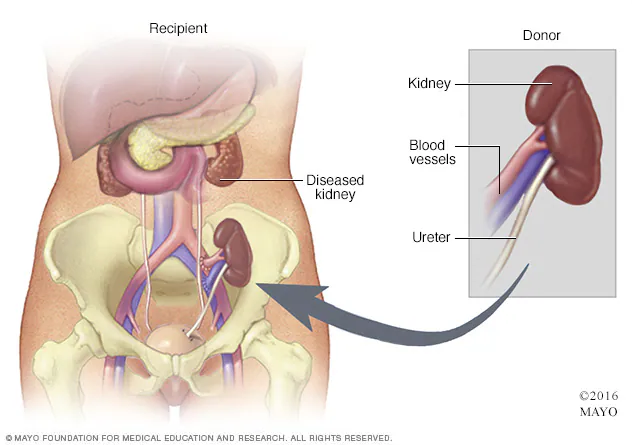 <p>Kidney donation from living or deceased donor</p><ul><li><p>Prefer left kidney from living (longer renal vein)</p></li><li><p>Placed in iliac fossa (mostly right)</p><ul><li><p>Extraperitoneal position</p></li><li><p>Increase vascularization + decrease complications</p></li></ul></li><li><p>Indication: Severe/end-stage renal disease</p></li></ul><p></p>