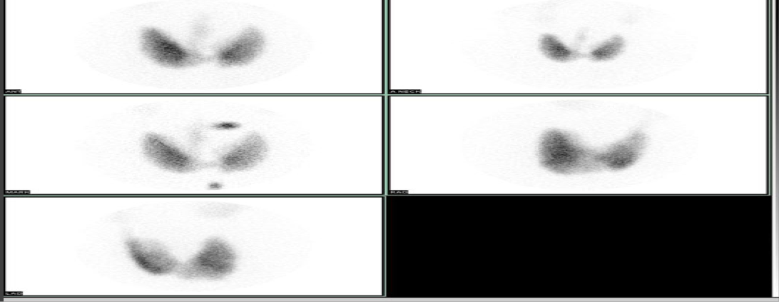 <p>NUCLEAR MED ONLY SHOWS FUNCTION-not anatomy</p><p>I-131 - take up by the thyroid tissue, used to evaluate thyroid abnormalities or to search for metastatic thyroid cancer </p>