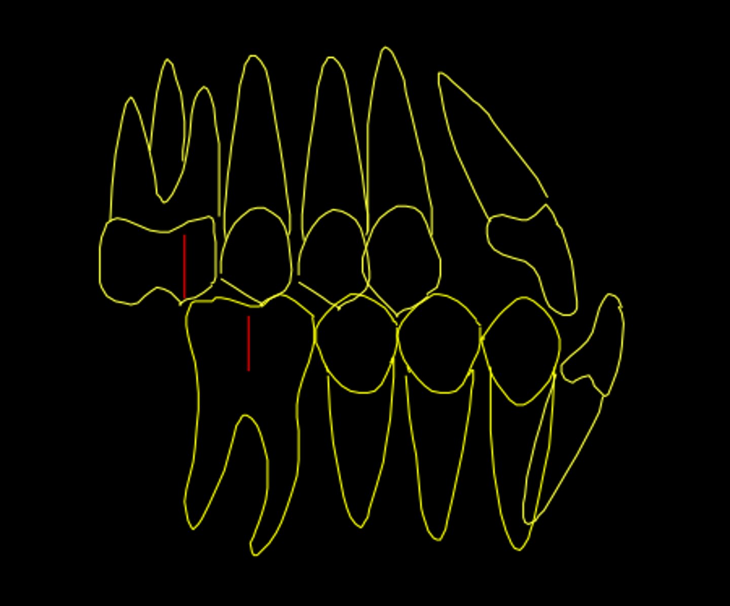 <p>ID the class of occlusion:</p>