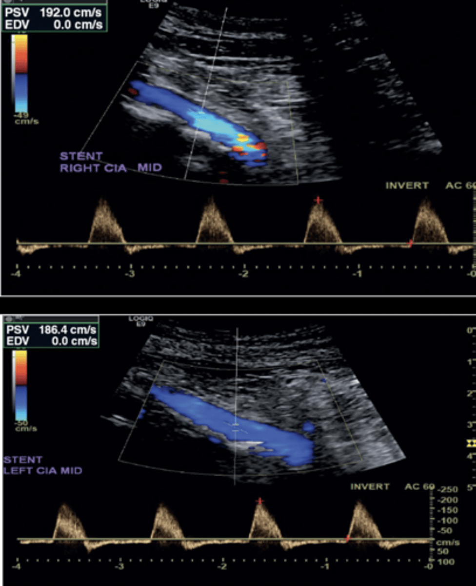 <p>Multiphasic</p><p>Evaluate prox to, at entrance, through, at exit, and distal to graft</p>