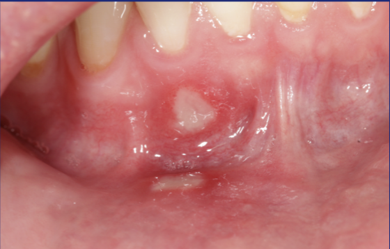<p>‘Complete loss of epithelium with exposure of the underlying connective tissue’</p>