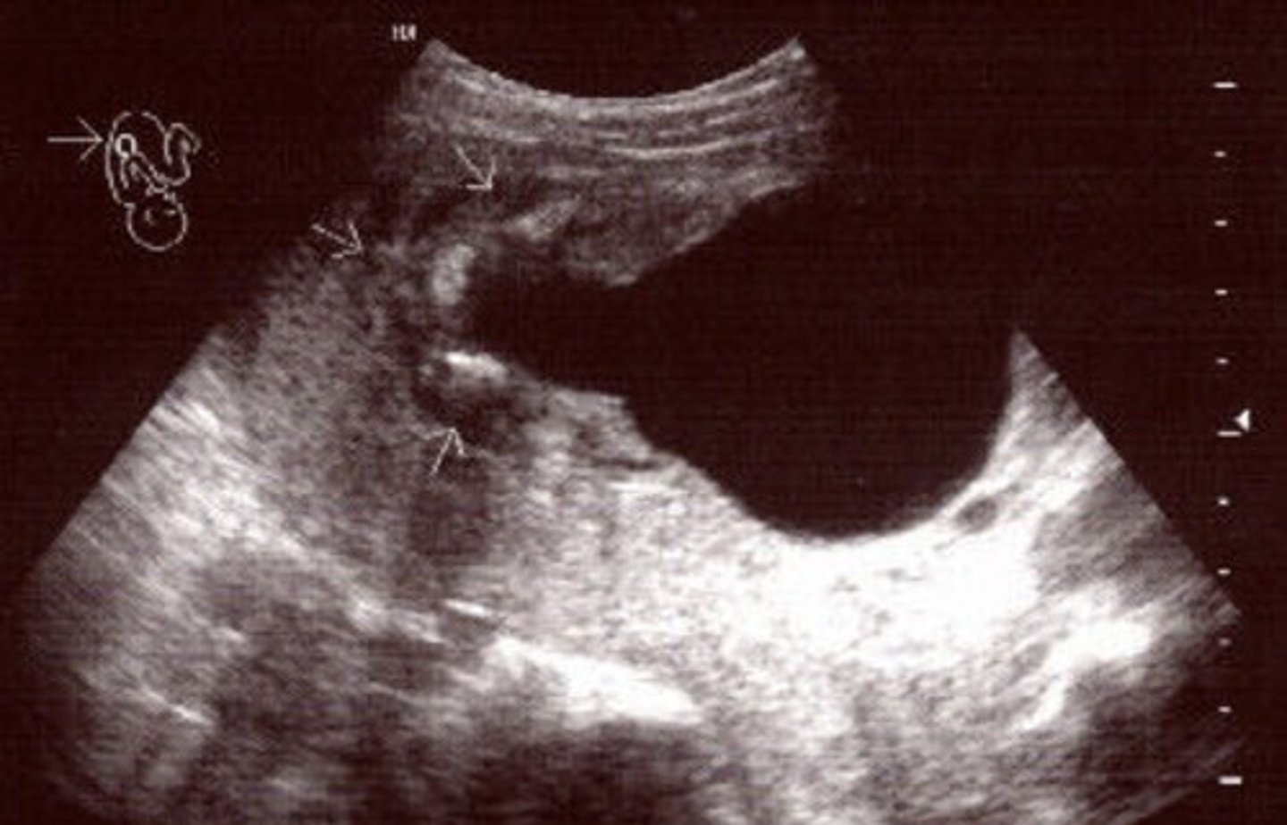 <p>Only in boys</p><p>Causes bilateral hydronephrosis</p><p>Thick bladder walls</p><p>Keyhole bladder appearance</p>