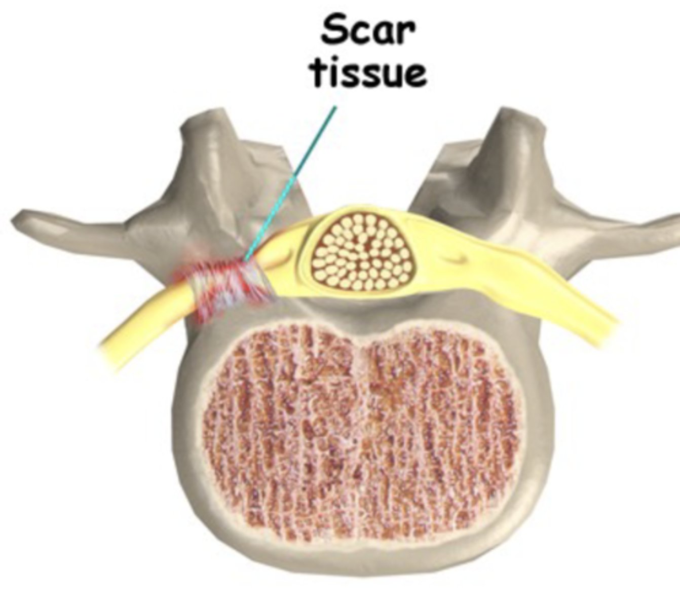 <p>- Increased ant. tilt, angled lower back</p><p>- Facet joint closed</p><p>- Scar forms where nerve adheres to tissue</p>