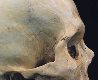 <p>Notch between temporal and frontal zygomatc</p>