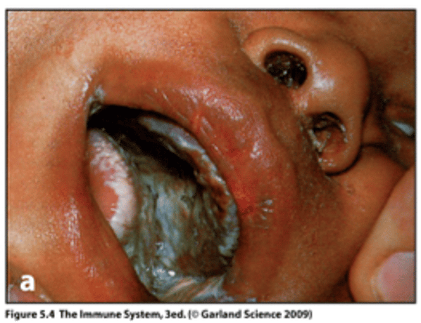 <p>results in the absence of both functional B and T cells</p><p>die in infancy from common infections unless they receive a bone marrow transplant</p><p>many genetic defects can lead to this</p><p>genetic defects that lead to T cell deficiencies are worst. why? because influences humoral and cell mediated. No T cells, no Ab produced either</p><p>one cause is a genetic deficiency of RAG1 or 2 proteins. If B and T don't successfully undergp VDJ recombination during development, these developing cells dine in the bone marrow or thymus</p>