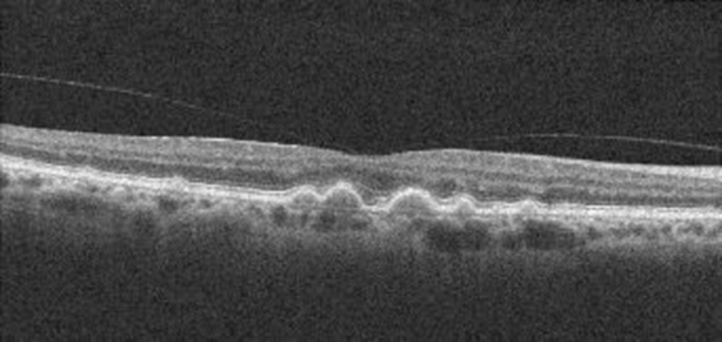 <p>localized RPE elevation (subRPE deposit)</p><p>large drusen RPE elevation called PED</p><p>Bruch's thin line can become visible now</p>