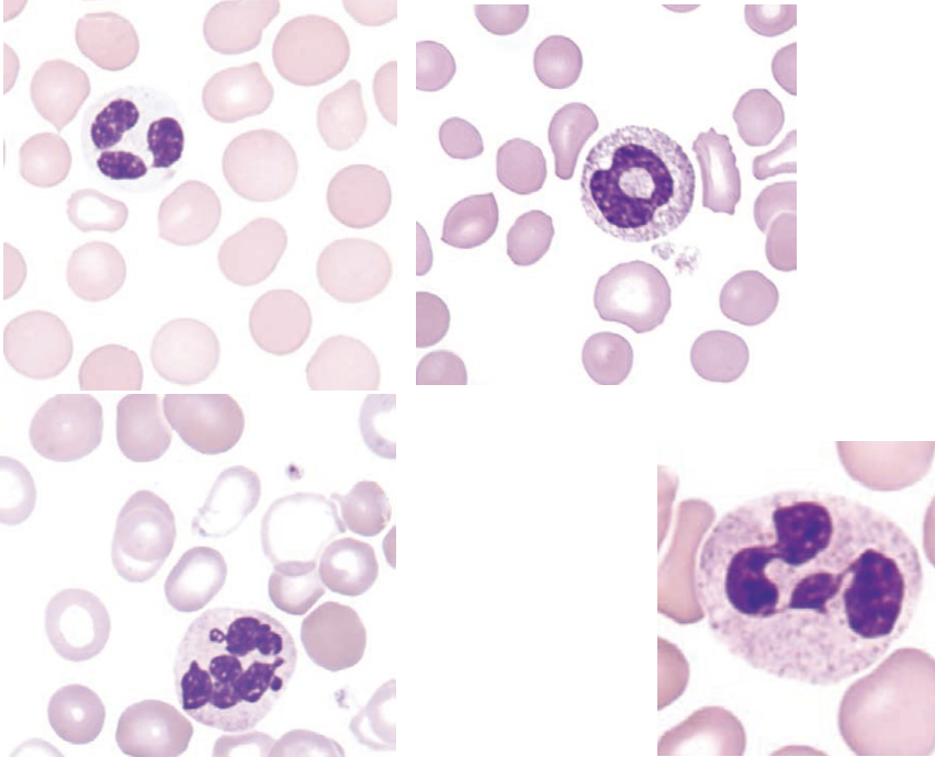 <p>these morphological abnormalities of the peripheral blood are characteristic of ____.</p>