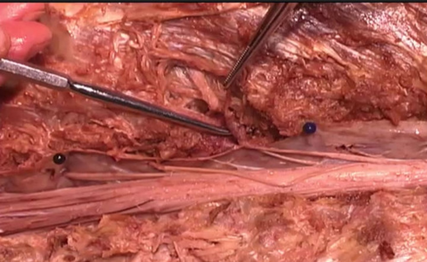 <p>Which swollen structure is being shown here?</p><p>anterior ganglion</p><p>ventral nerve</p><p>dorsal root ganglion</p><p>inferior ganglion</p>