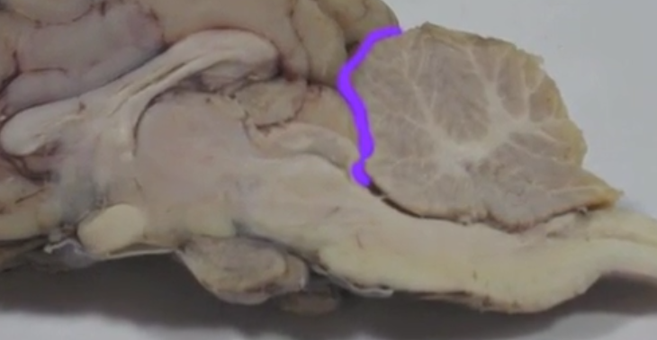 <p>Transverse fissure </p>