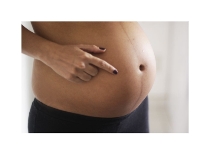 <p><span style="background-color: transparent;"><span>some mothers will experience an up regulation of melanocytes, causing more pigment right through the midsagittal plane of abdomen</span></span></p>