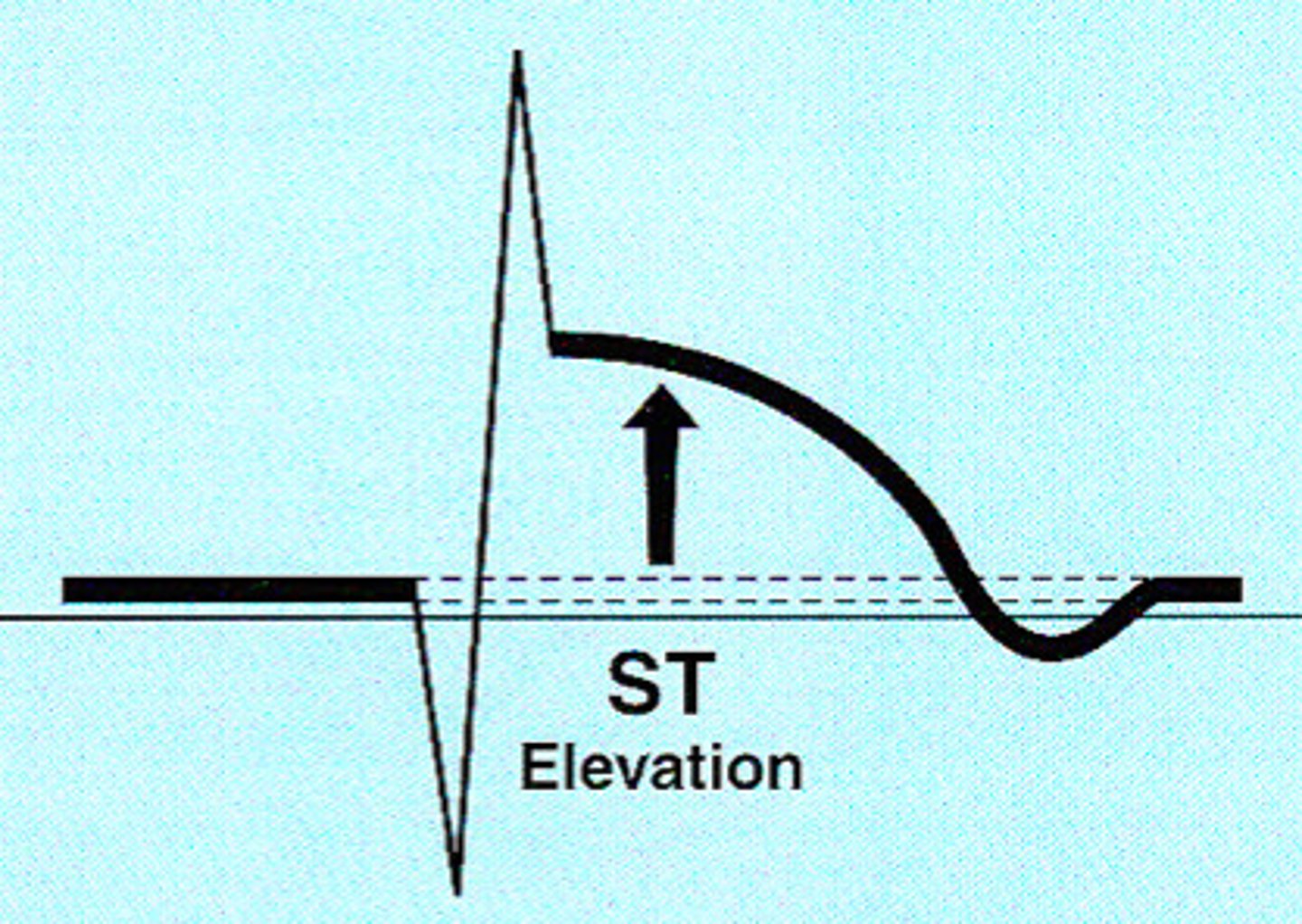 <p>ST segment elevation (a sign of acute injury going on presently) (look for sad face)</p><p>- Injury indicates the acuteness of an infarct (acute or recent)</p><p>- can still save heart cells/reverse</p>