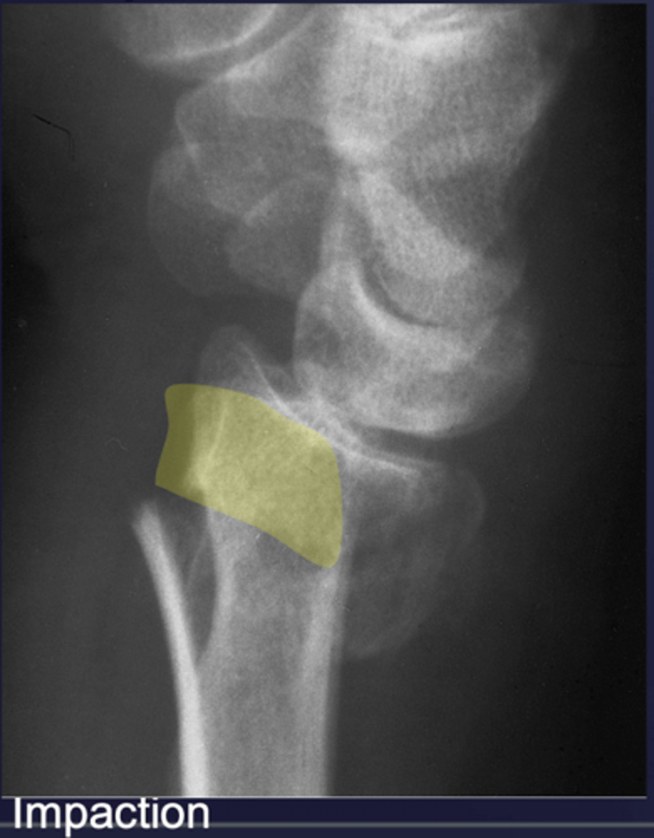 <p>Impaction (ex: compression fractures, endplate impacted; CT can help define location and the extent)</p>