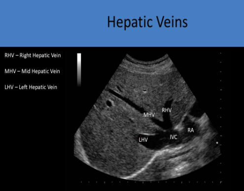 <p>Subc trans view, angles to RT shoulder</p>