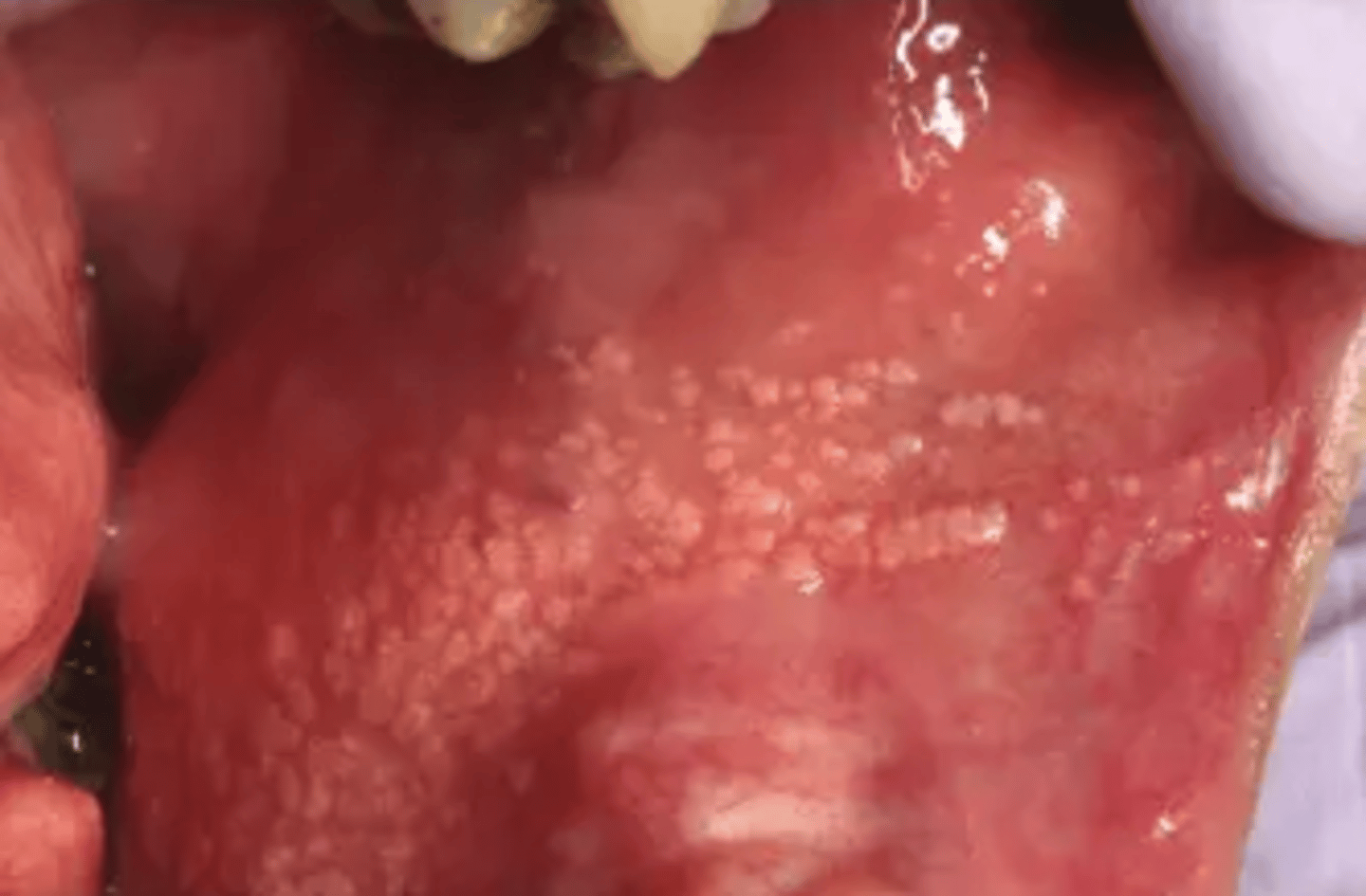 <p>Talgkörtlar i slemhinnan som antingen kan ligga ensamt eller samlad, är gulvita till färgen</p>