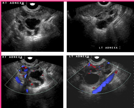 <p>What presents as a cystic mass after bilateral oophorectomy?</p>
