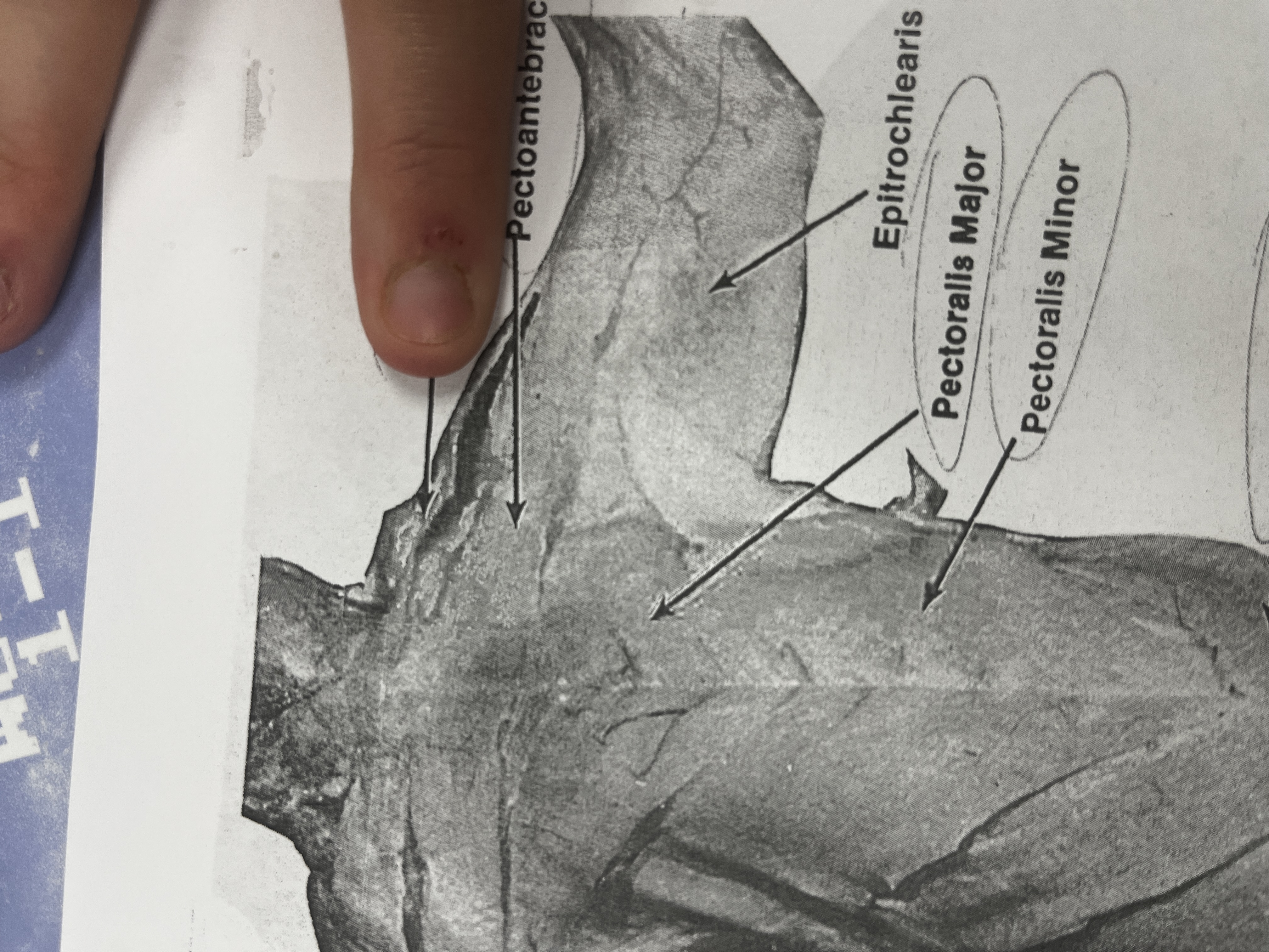 <p>A shoulder muscle that aids in arm movement.</p>