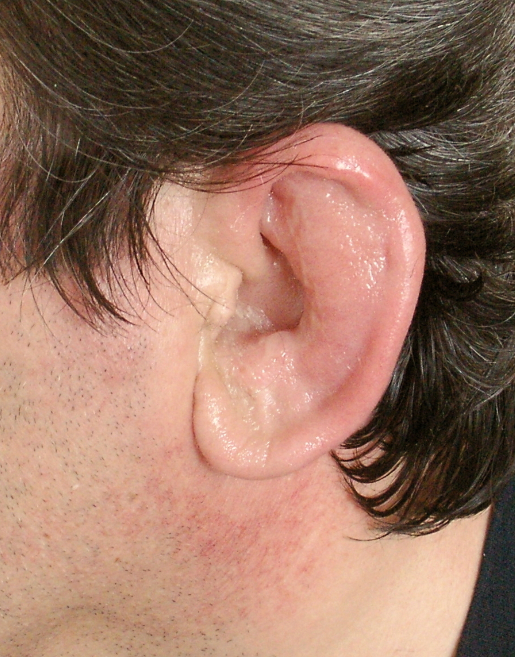 <p>Location: Pinna</p><ul><li><p>Infection of tissue surrounding cartilage</p><ul><li><p>Bacterial infection with swelling</p></li><li><p>Redness</p></li><li><p>Pain</p></li></ul></li></ul><p></p>