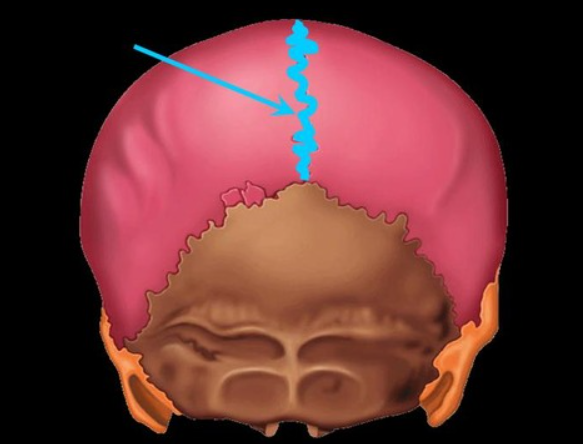 <p>sits between the right and left parietal bone</p>