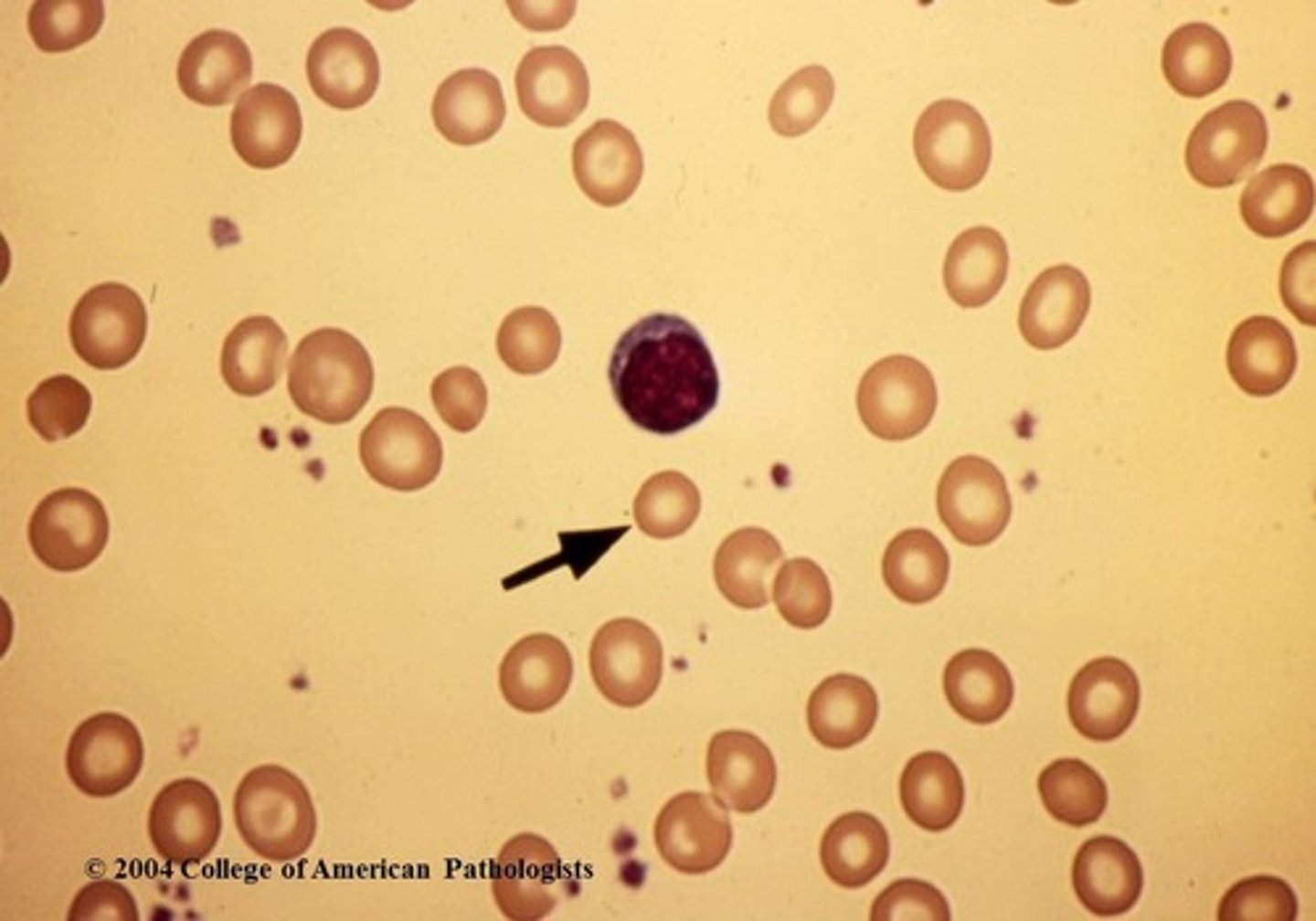 <p>small RBC</p><p>&lt;80 fL</p><p>smaller than a small lymphocyte&nbsp;</p>