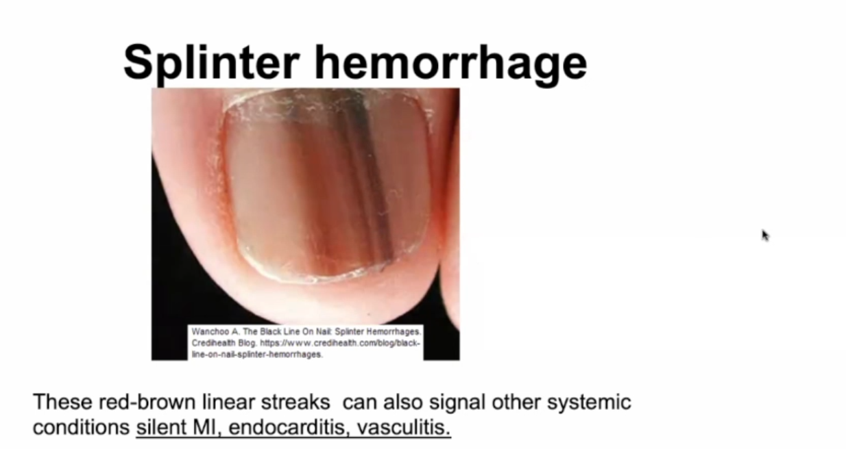 <ul><li><p>A &amp; D</p></li><li><p>Splinter Hemorrhage</p></li></ul><p></p>