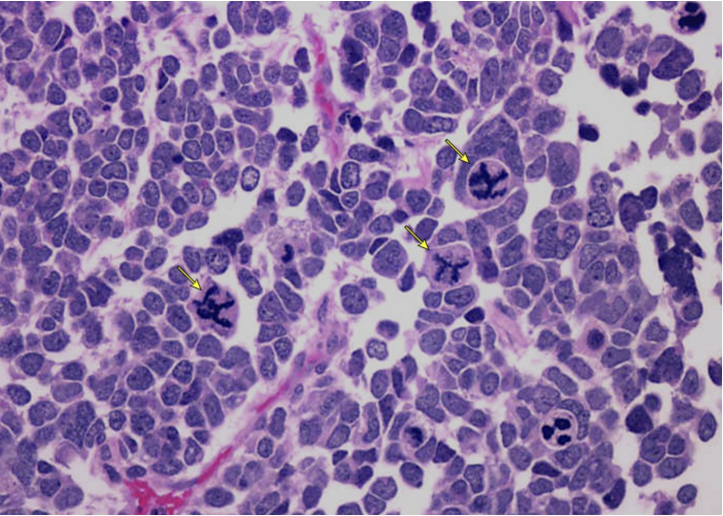 <p>What would a unfavorable biopsy of Wilms tumor look like?</p>