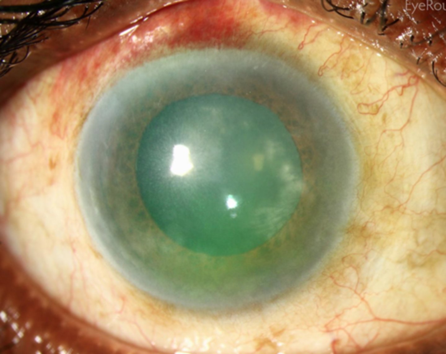 <p>development of a ground-glass appearance of the cornea and scleral vascularization, which have their onset around puberty; associated with hutchinson's triad</p>