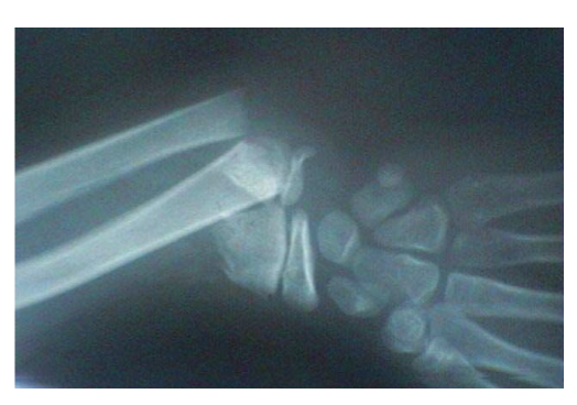 <p>What was the mechanism of injury for this x-ray?</p>