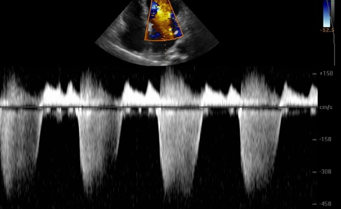 <p>Identify the spectral Doppler waveform:</p>