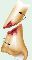 spiral fracture 